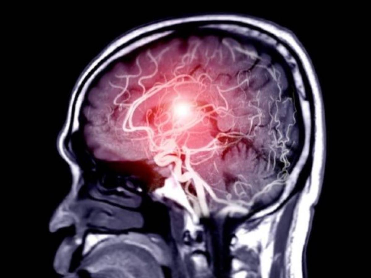 ¿Qué sabemos actualmente sobre los efectos del SARS-CoV-2 en el cerebro?