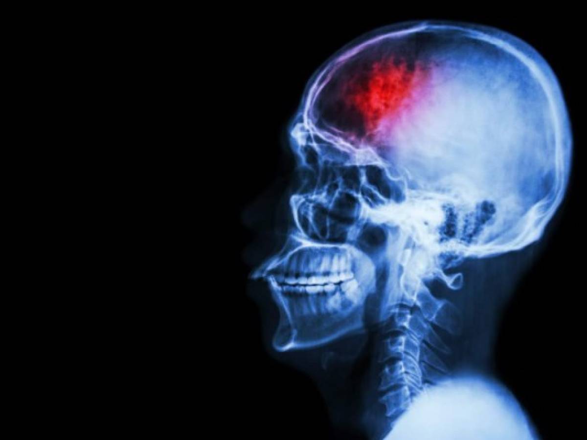 Opinión: Covid-19 y el misterio del ataque al cerebro