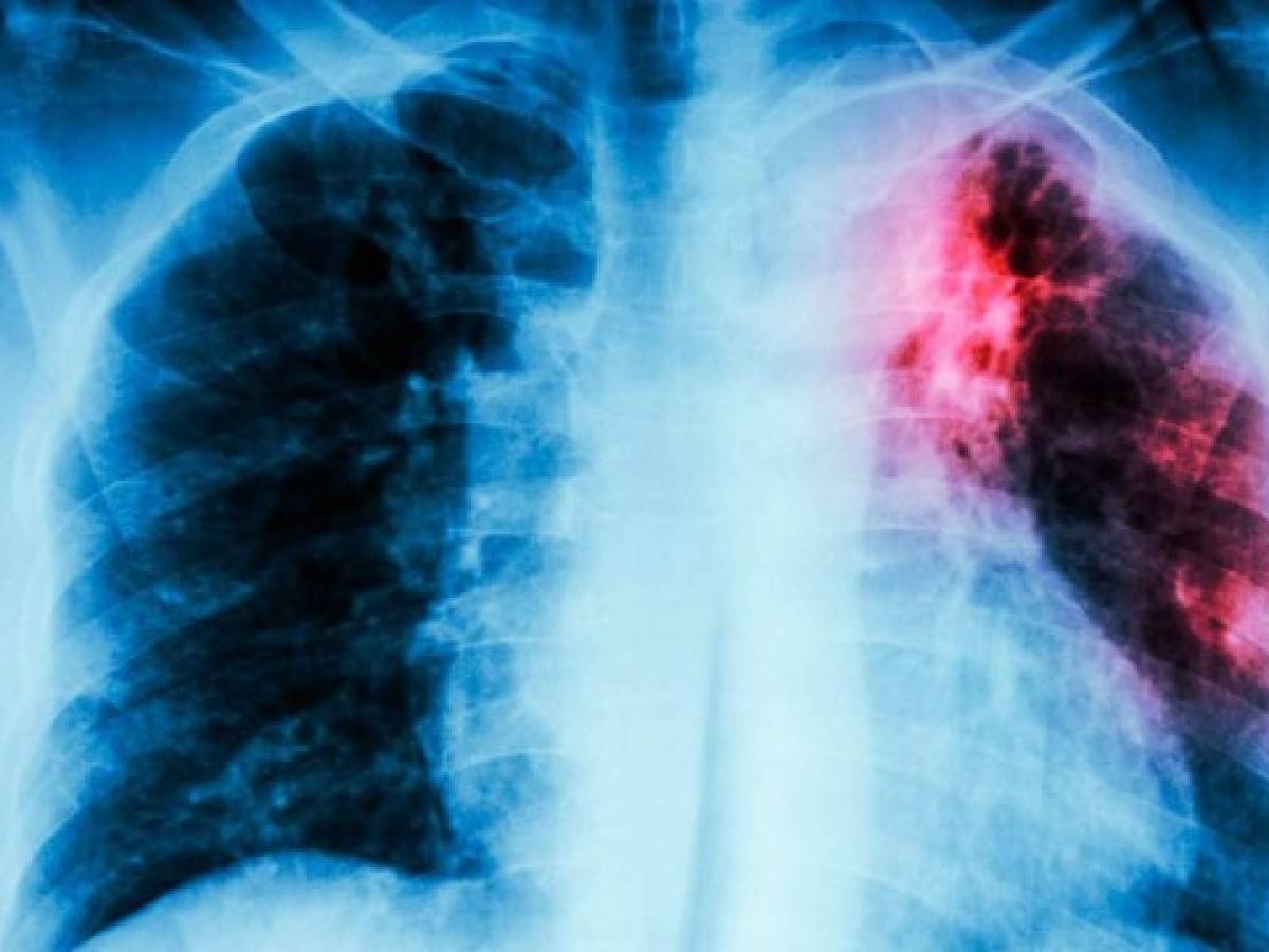 El número de muertos por tuberculosis sube por la pandemia de covid-19