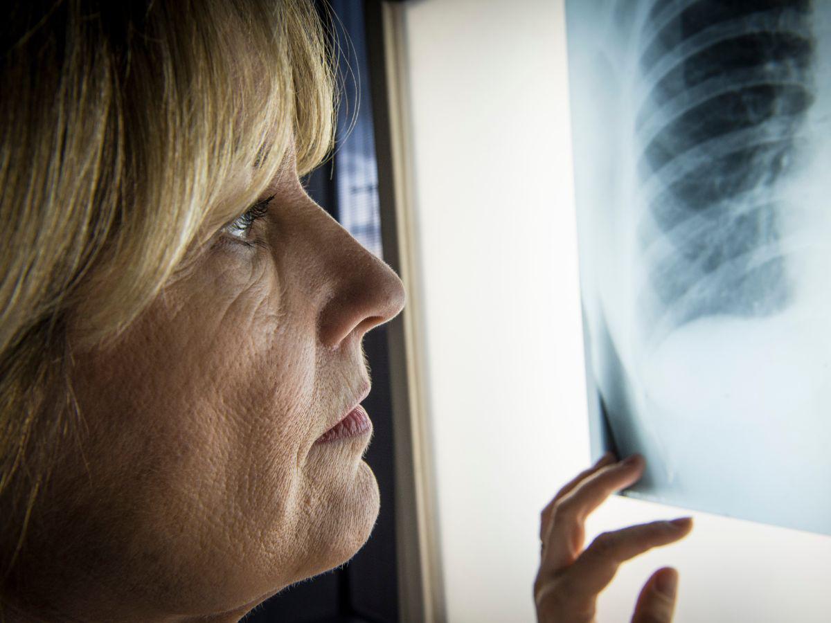 Enfermedad Pulmonar Obstructiva Crónica (EPOC): tercera causa de muerte a nivel mundial