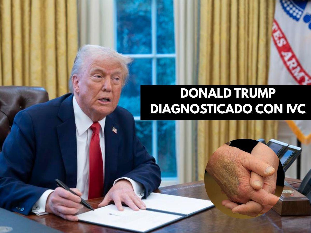 Insuficiencia venosa: enfermedad que padece Donald Trump