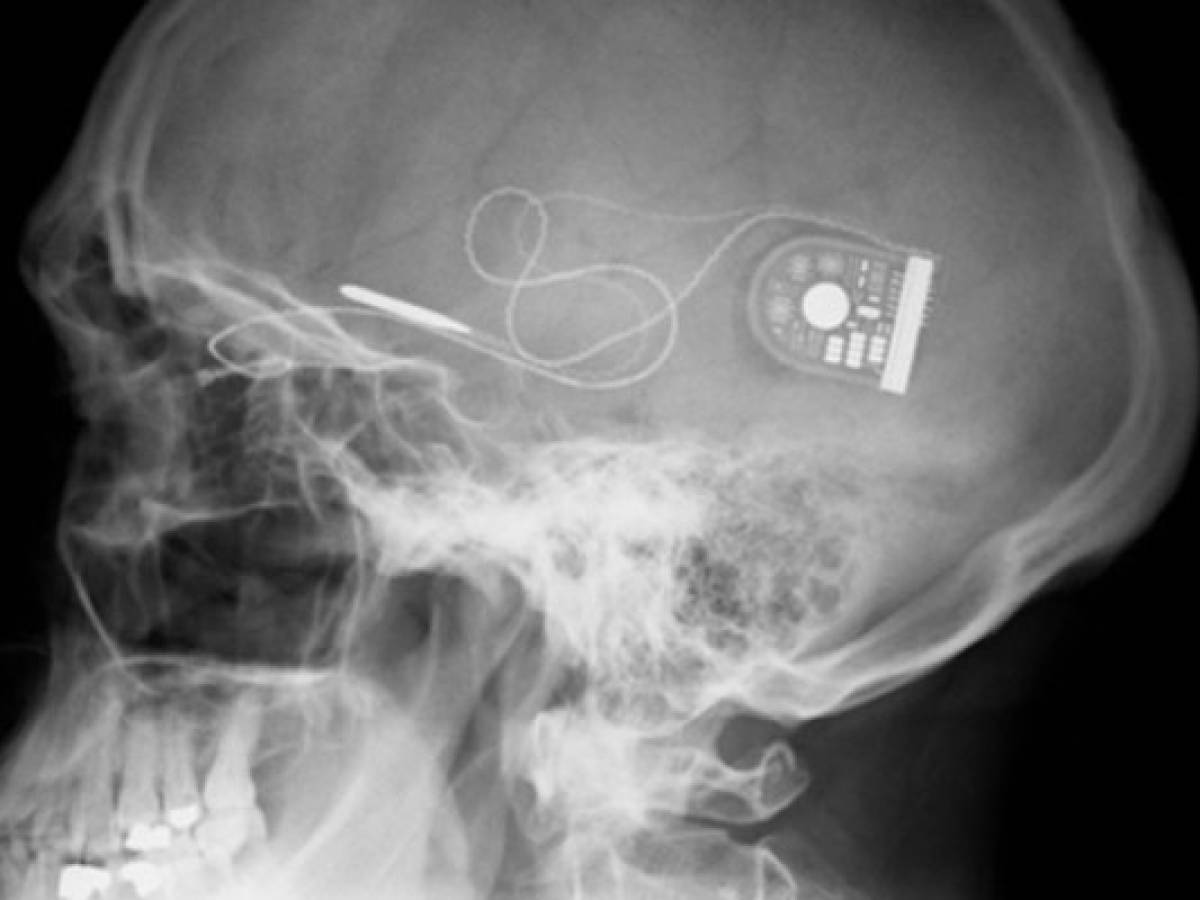 Crearon un chip que devuelve la vista