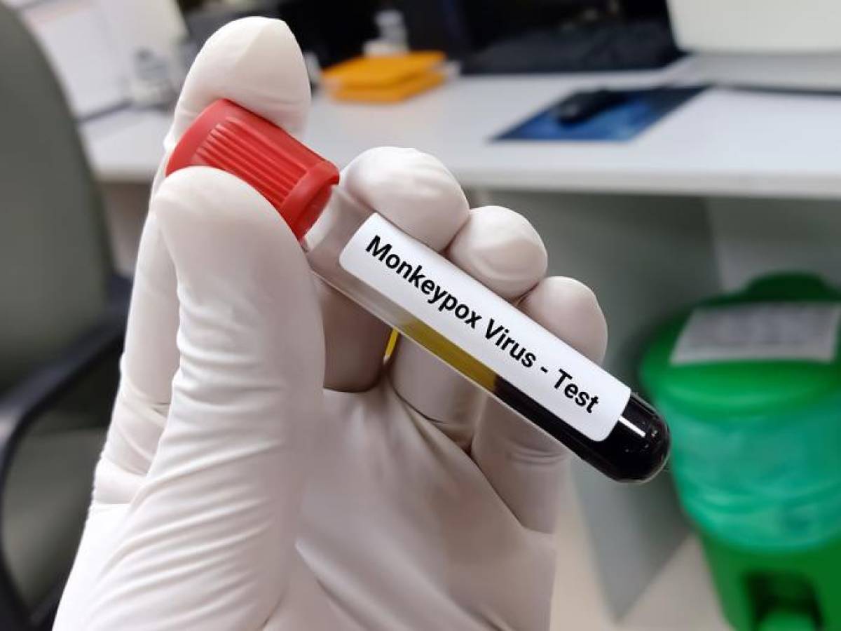 El Salvador acumula siete casos de viruela símica