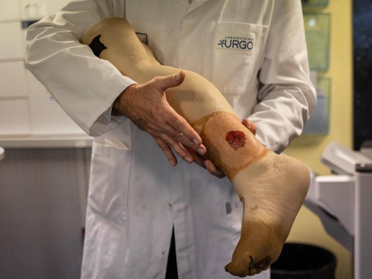 Crean piel artificial para cicatrizar las quemaduras graves