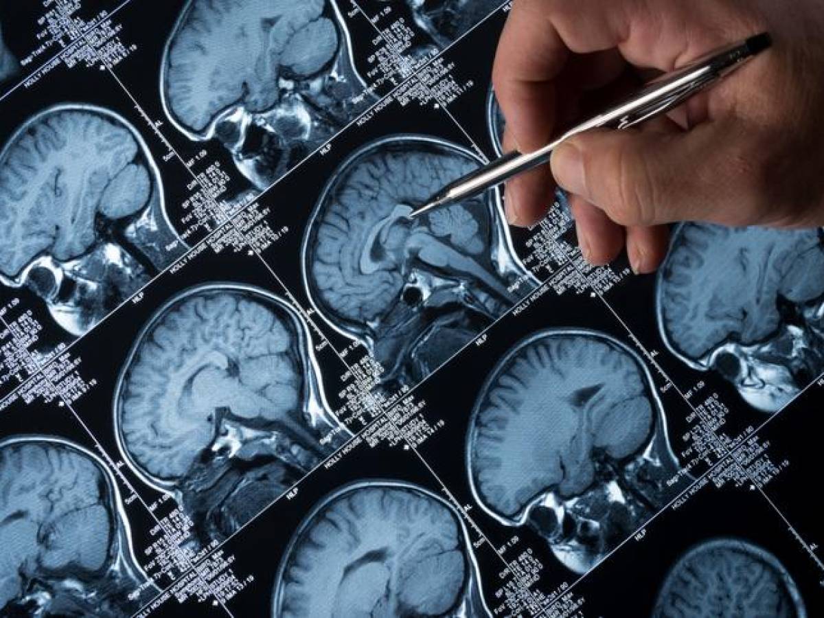 Consiguen predecir si un anciano sano desarrollará Alzheimer