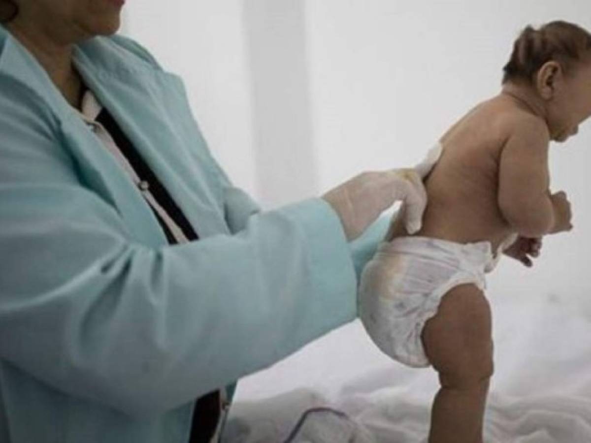 Ya son 9 casos de microcefalia por zika en Honduras