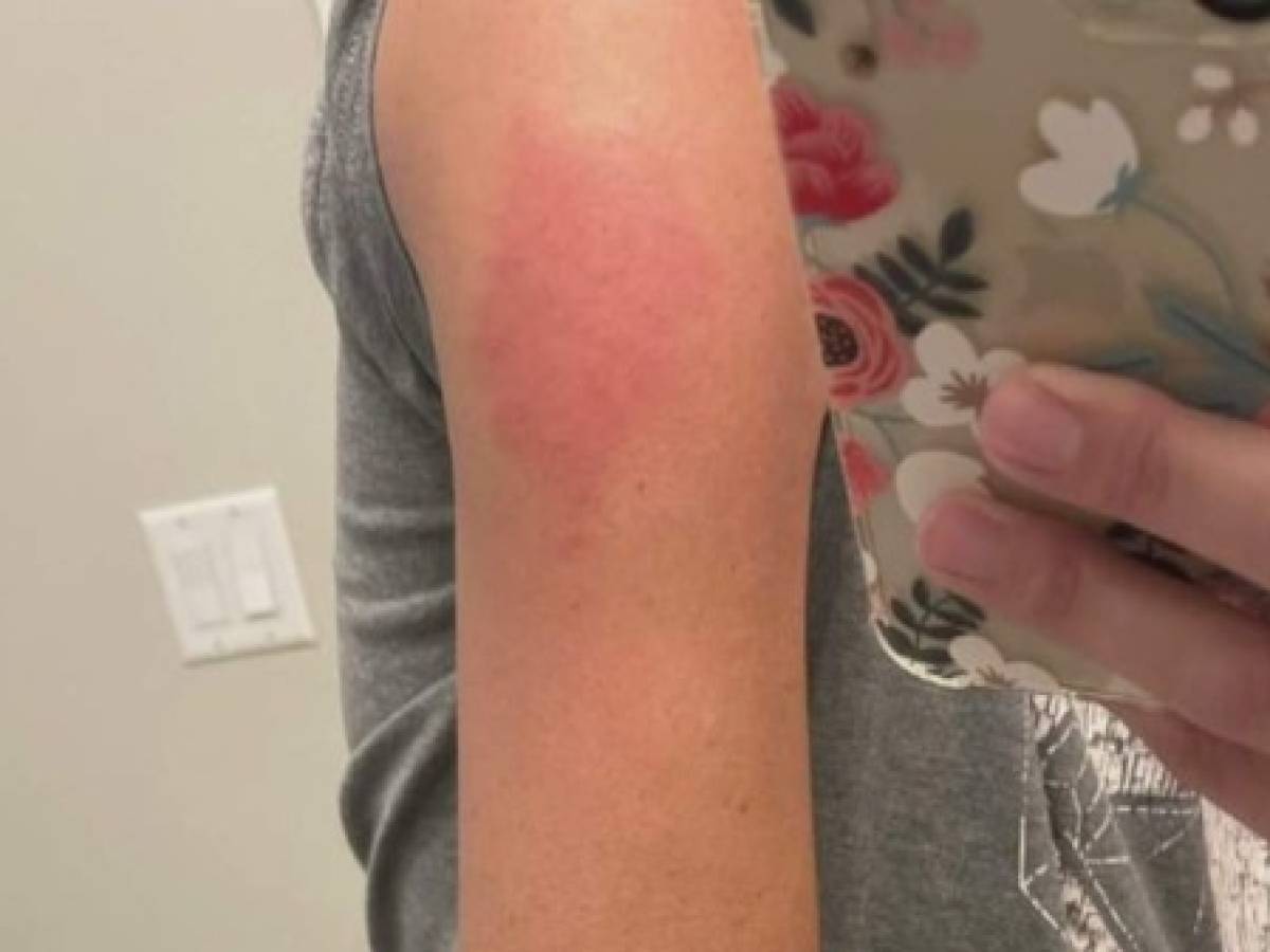 'Brazo COVID': el sarpullido que causa la vacuna de Moderna en algunas personas