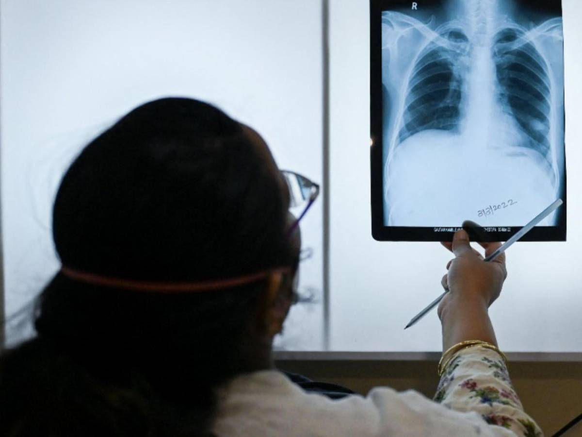 OMS advierte que la tuberculosis vuelve a propagarse en el mundo