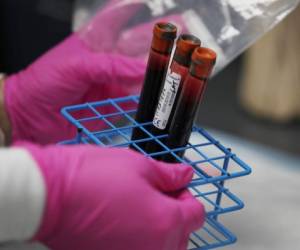 HOLLYWOOD, FLORIDA - AUGUST 07: A patients blood samples are seen during a COVID-19 vaccination study at Research Centers of America on August 07, 2020 in Hollywood, Florida. Research Centers of America is currently conducting COVID-19 vaccine trials, implemented under the federal government's Operation Warp Speed program. The center is recruiting volunteers to participate in the clinical trials, working with the Federal Government and major Pharmaceutical Companies, that are racing to develop a vaccine to potentially prevent COVID-19. Joe Raedle/Getty Images/AFP