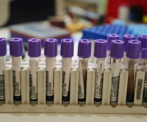 A tray with blood samples belonging to covid 19 and endemic diseases like dengue, malaria, chikunguya and leptospirosis are worked-on at the lab of the Cesar Garayar support hospital in the city of Iquitos, in the Amazon basin, on May 22, 2020. - Focused attention on fighting the new coronavirus in Peru has detracted the ability to combat the dengue fever, an explosive situation in the Amazon region, where it is leaving a trail of disease and death in cities and remote indigenous villages. (Photo by Cesar Von BANCELS / AFP)