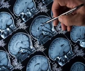 Consiguen predecir si un anciano sano desarrollará Alzheimer