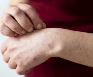 Las joyas, fragancias, lociones y muchas otras sustancias pueden causar una reacción cutánea conocida como dermatitis de contacto. Foto de cortesía