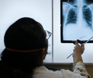 OMS advierte que la tuberculosis vuelve a propagarse en el mundo