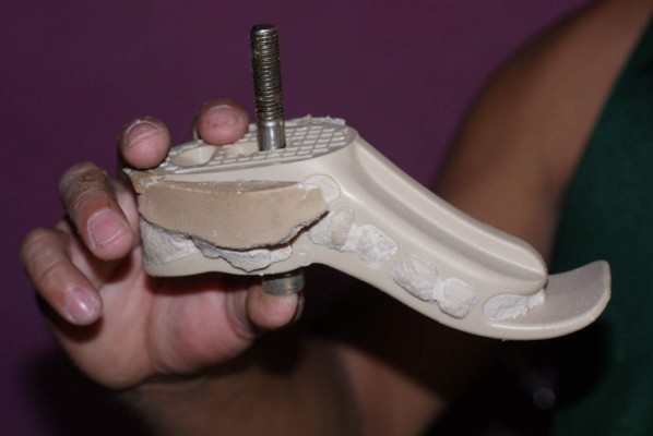 Nicaragua: Víctimas de minas enfrentan apatía y burocracia