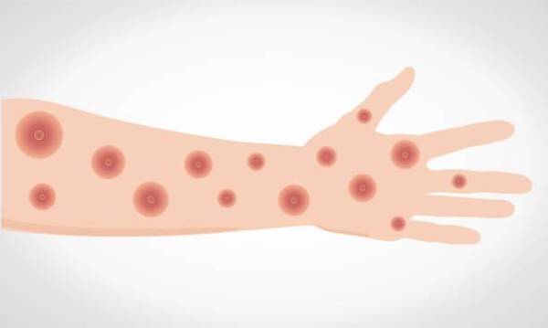 Monkeypox virus. Wounds on the hand and arm. Vectorial