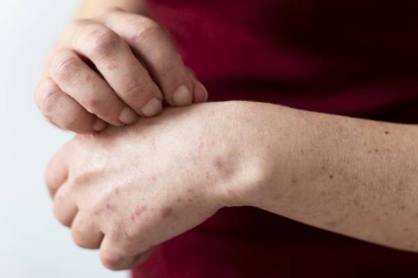 Las joyas, fragancias, lociones y muchas otras sustancias pueden causar una reacción cutánea conocida como dermatitis de contacto. Foto de cortesía